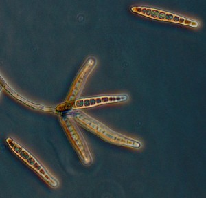 meningitis-exserohilum2